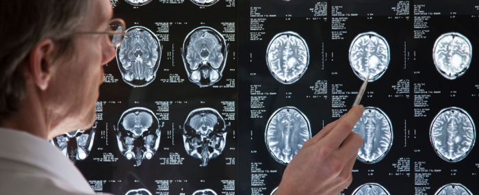 IRM_illustrationpage_neurinome de l'acoustique